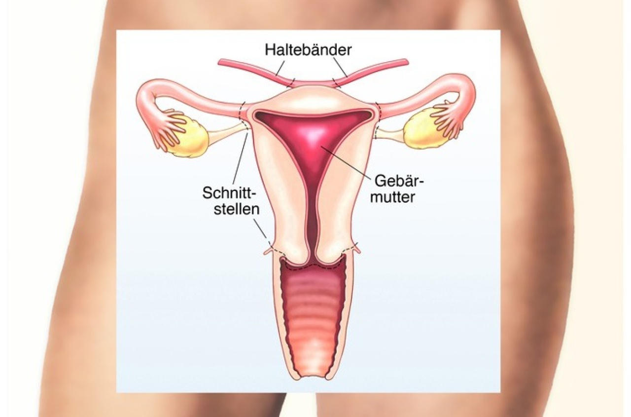 Eierstöcke entfernung gebärmutter und Gebärmutterentfernung (Hysterektomie)