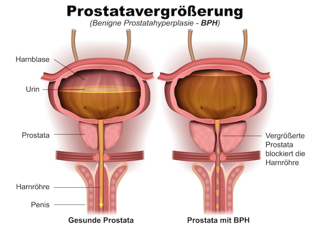 prostata probleme mann