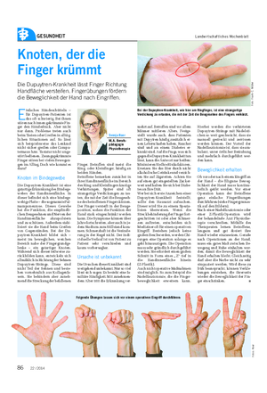 GESUNDHEIT Landwirtschaftliches Wochenblatt Knoten, der die Finger krümmt Die Dupuytren-Krankheit lässt Finger Richtung Handfläche versteifen.